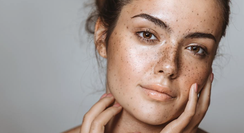 How To Treat Hyperpigmentation